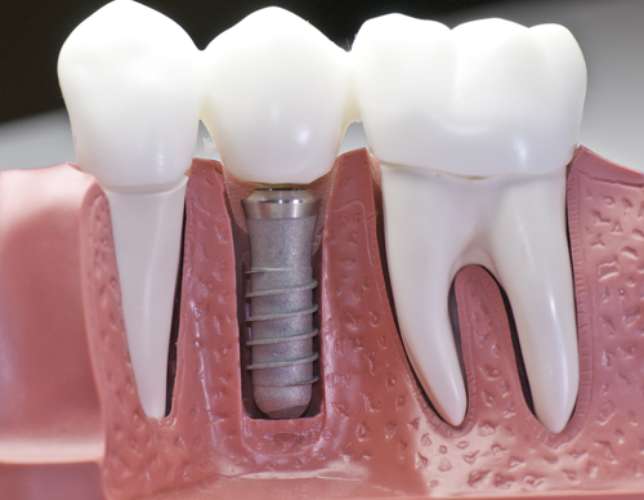Foto de Implante dentário
